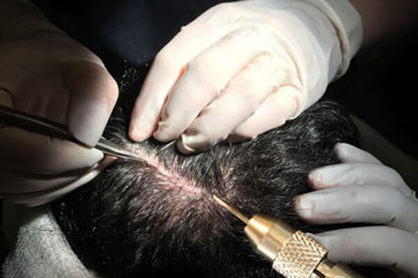 Пересадка волос по методике Long Hair FUE